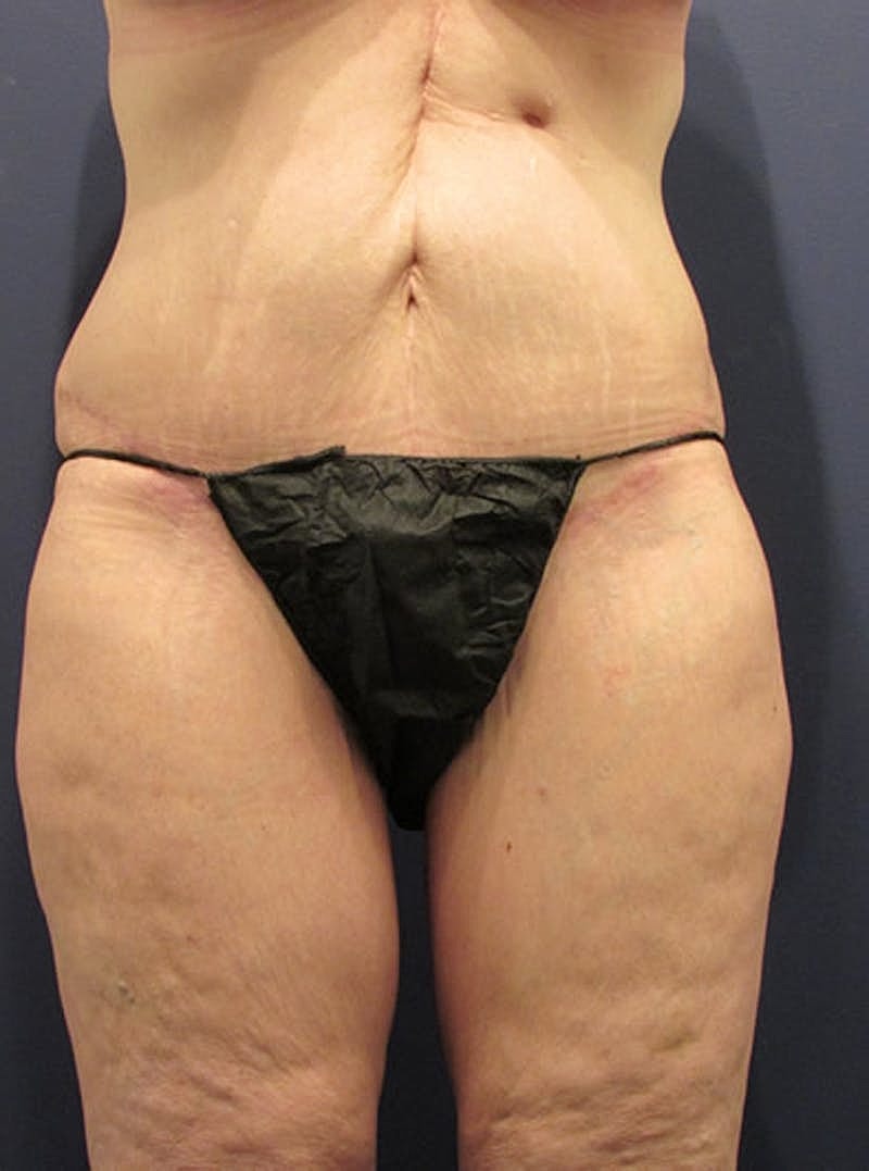 Tummy Tuck Before & After