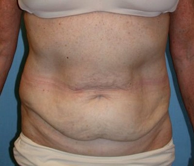 Tummy Tuck Before & After