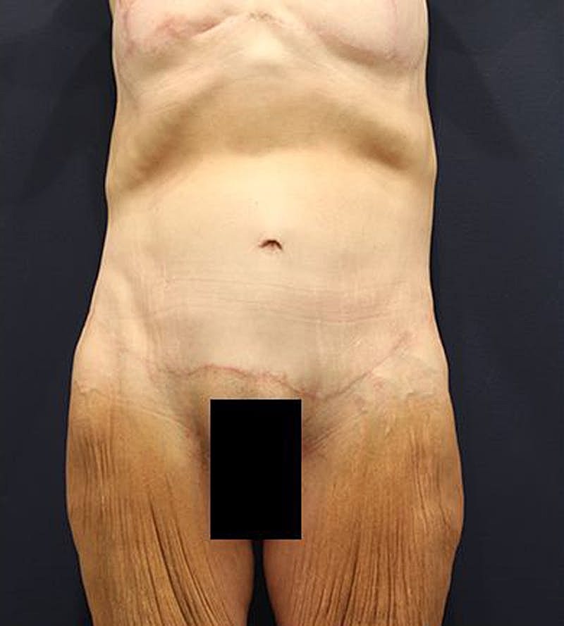 Tummy Tuck Before & After