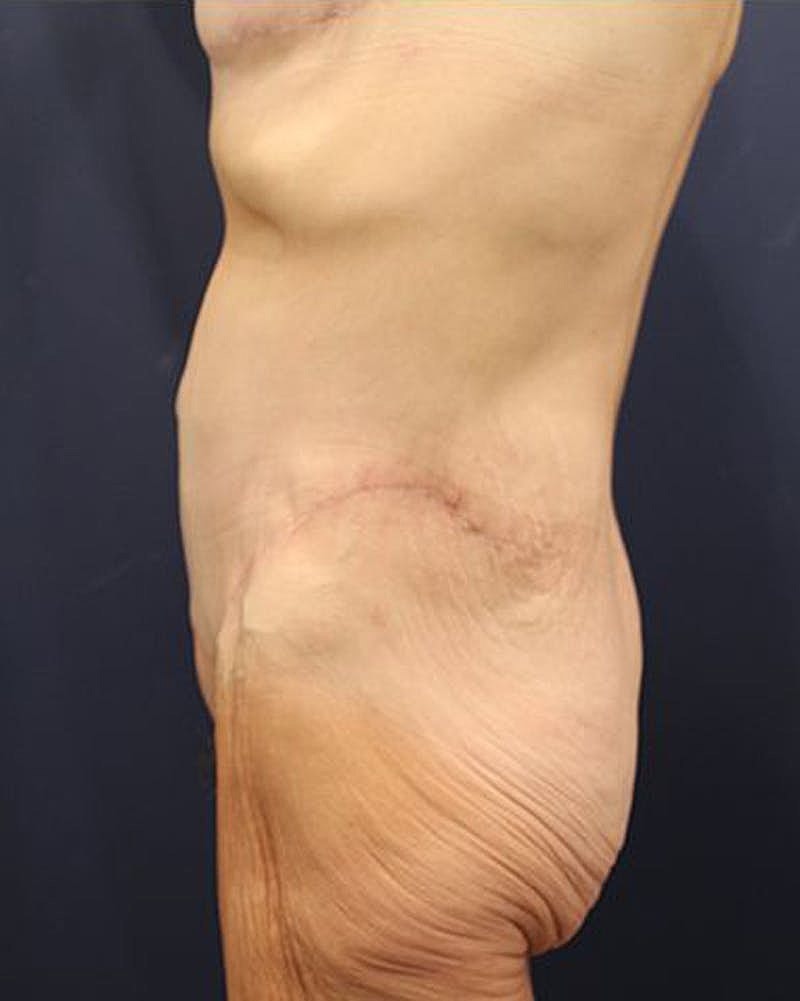 Tummy Tuck Before & After