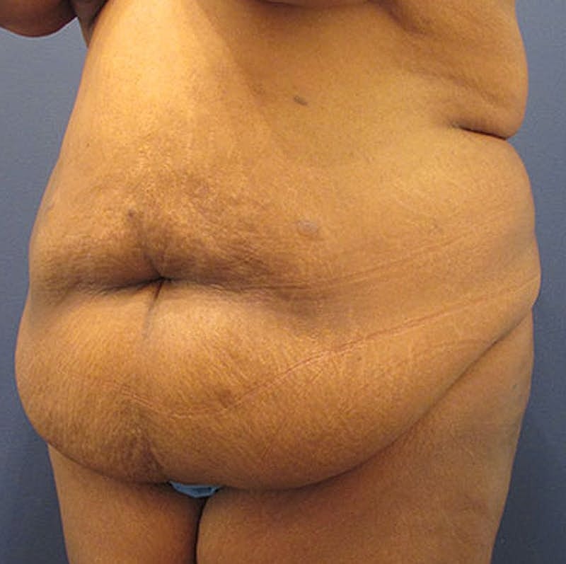 Tummy Tuck Before & After