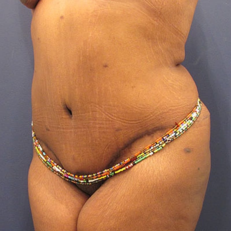 Tummy Tuck Before & After
