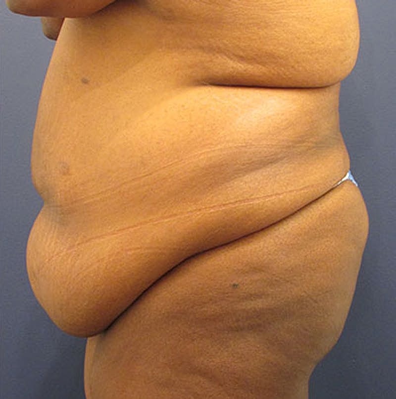 Tummy Tuck Before & After