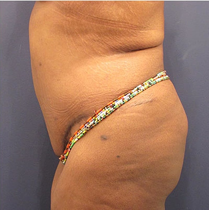 Tummy Tuck Before & After
