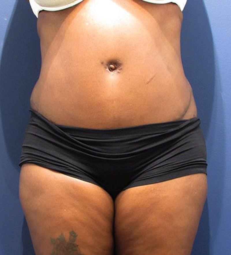 Tummy Tuck Before & After