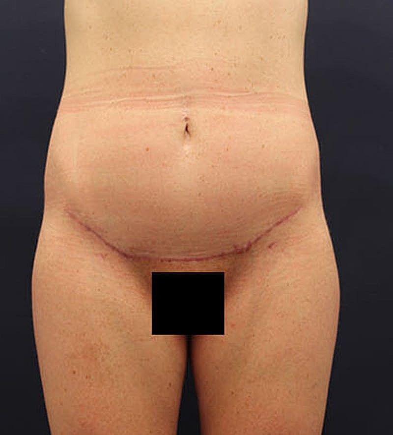 Tummy Tuck Before & After