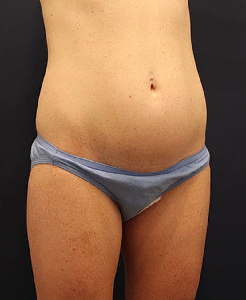 Tummy Tuck Before & After