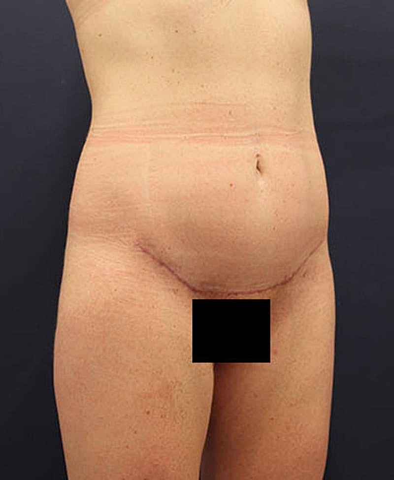Tummy Tuck Before & After