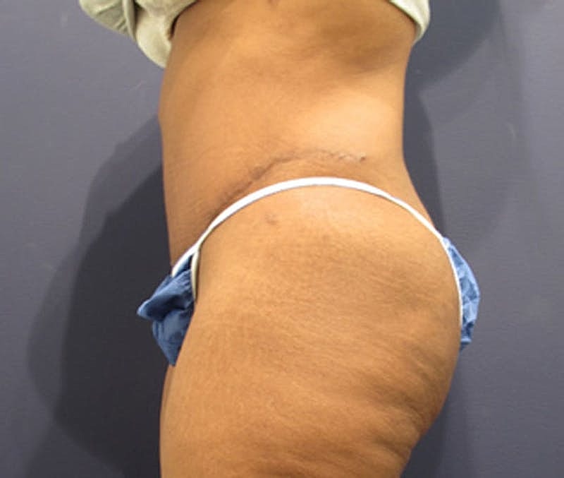 Tummy Tuck Before & After