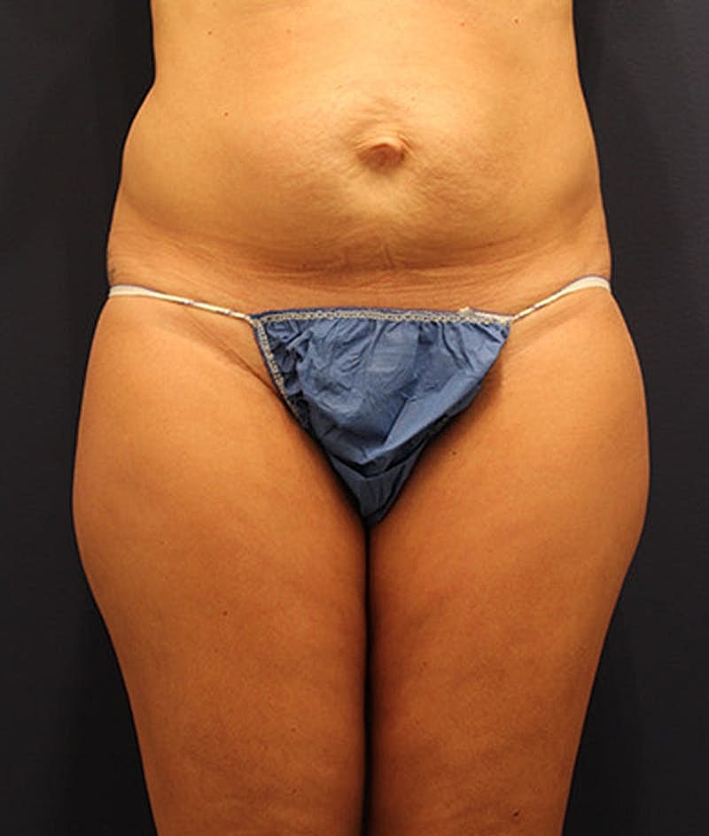 Tummy Tuck Before & After