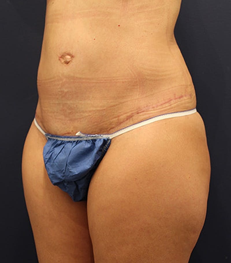 Tummy Tuck Before & After