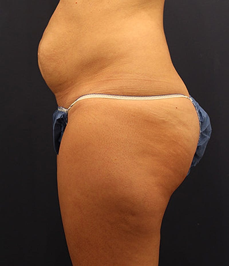 Tummy Tuck Before & After