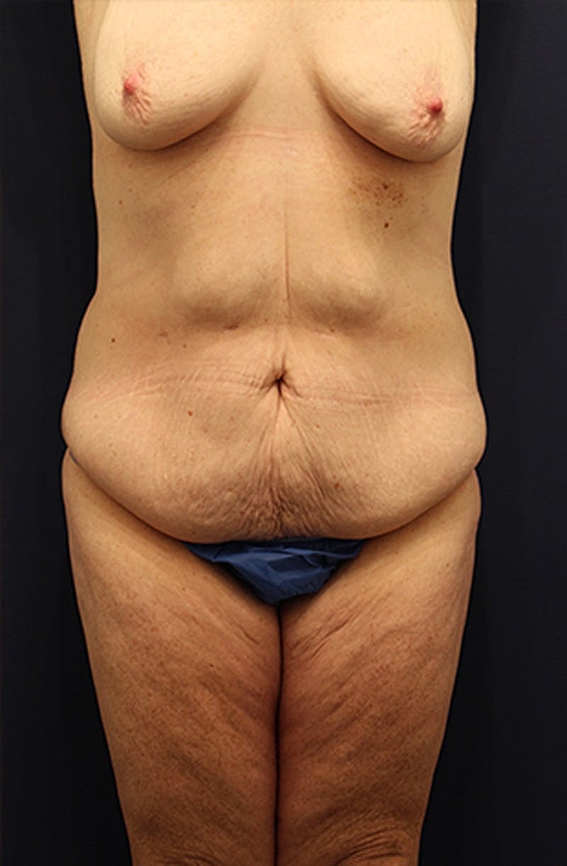 Tummy Tuck Before & After