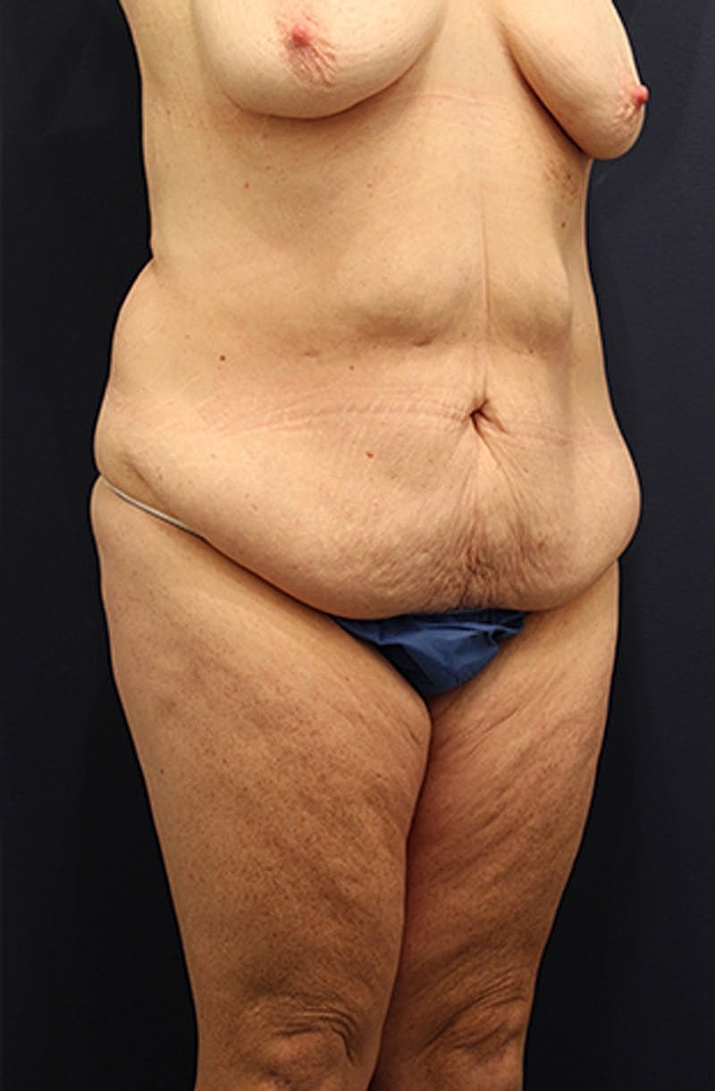 Tummy Tuck Before & After