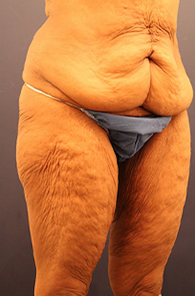 Tummy Tuck Before & After