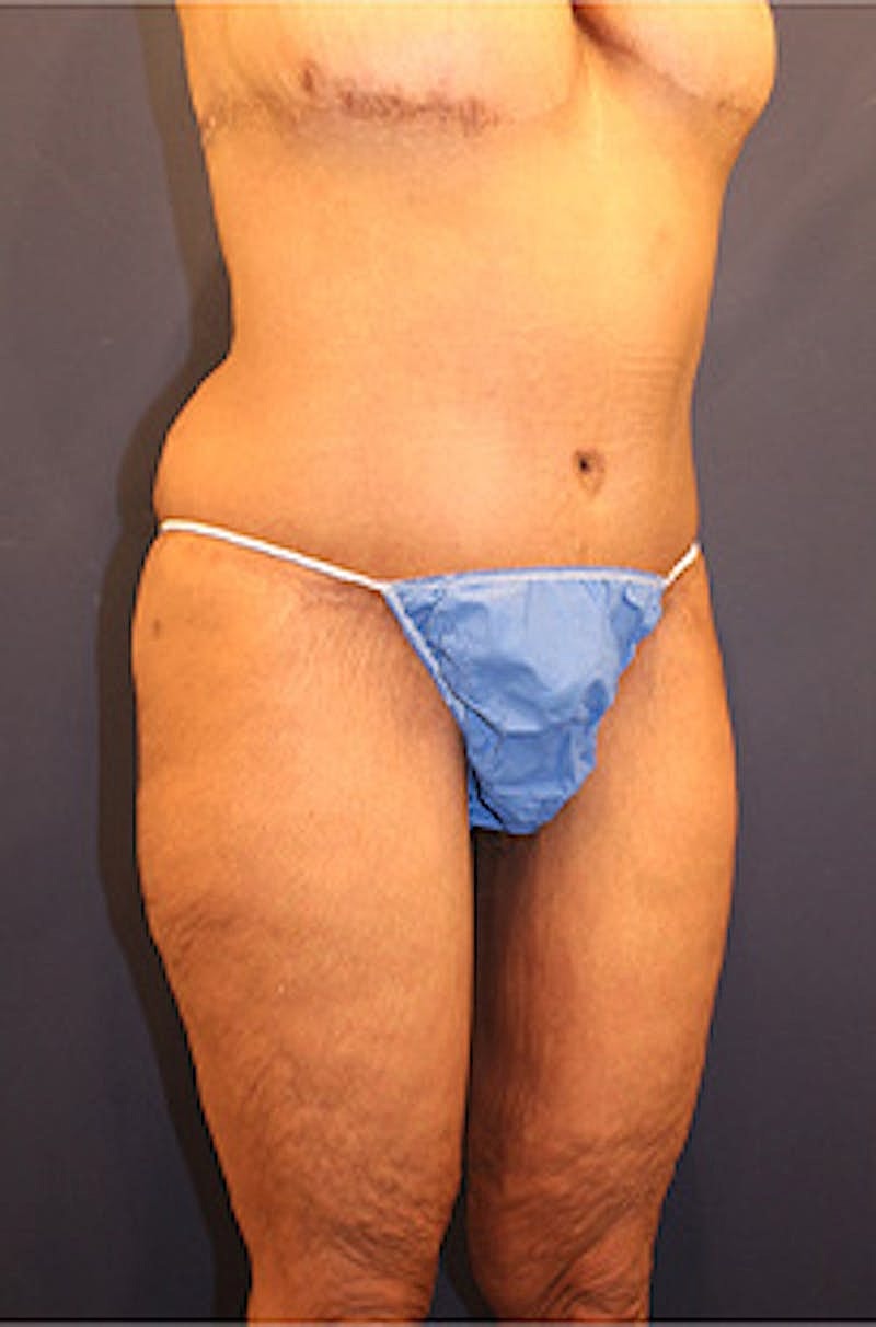 Tummy Tuck Before & After