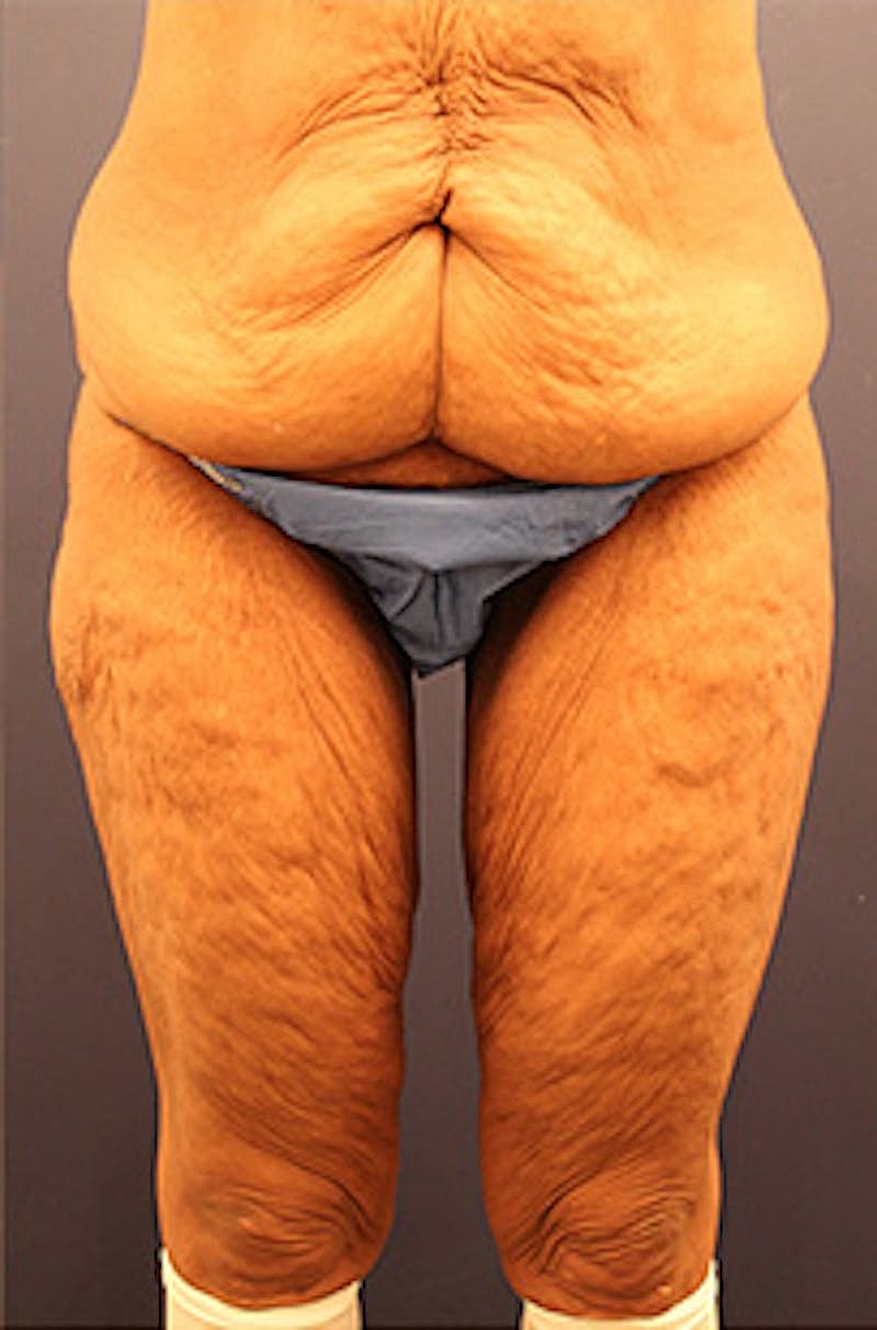 Tummy Tuck Before & After