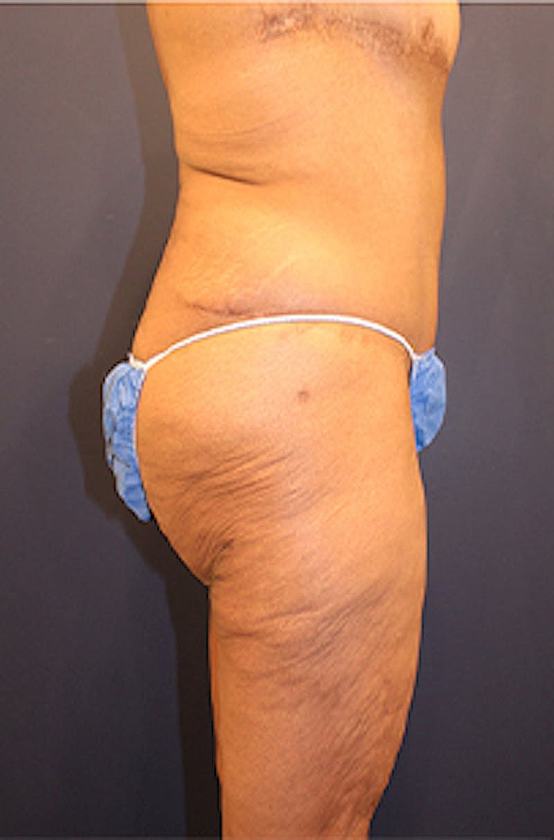Tummy Tuck Before & After