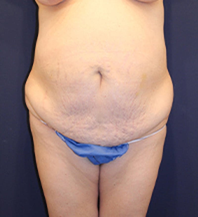 Tummy Tuck Before & After