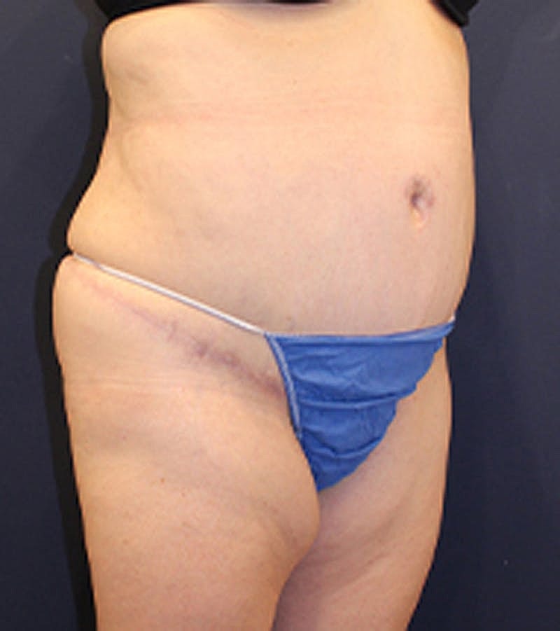 Tummy Tuck Before & After