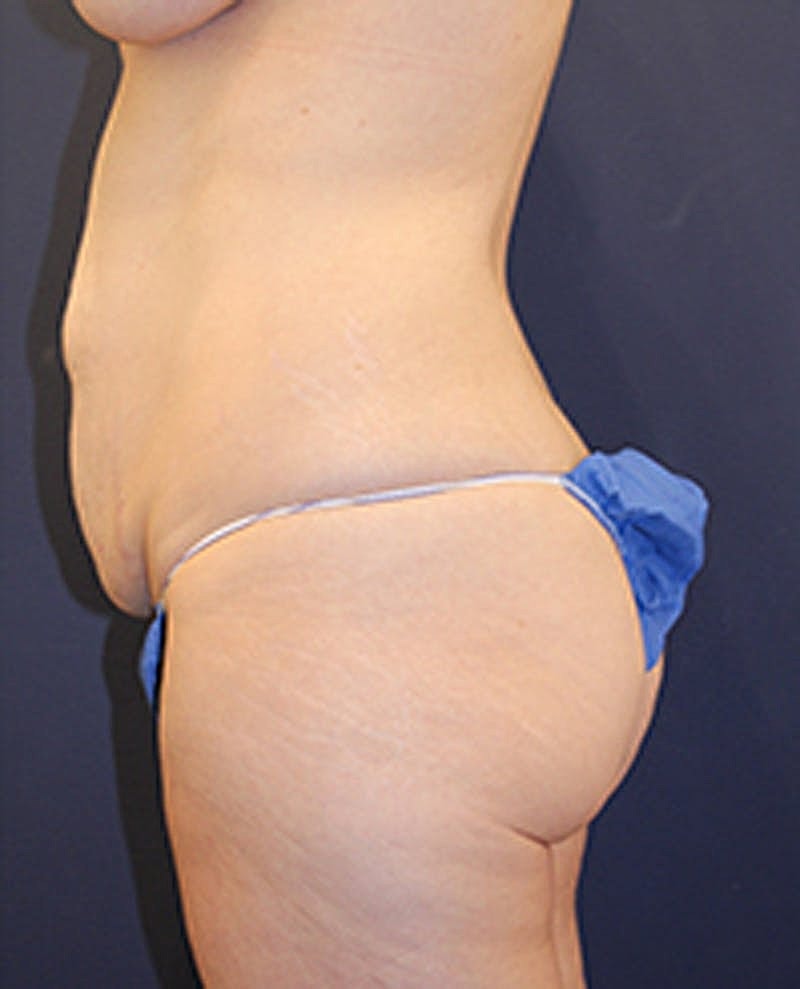 Tummy Tuck Before & After
