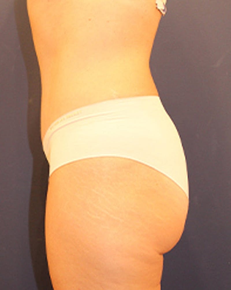 Tummy Tuck Before & After