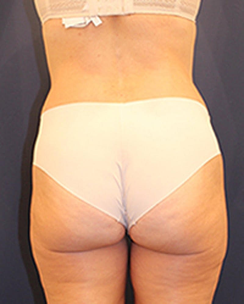 Tummy Tuck Before & After