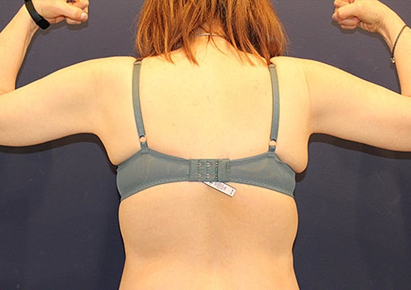 Arm Lift Before & After