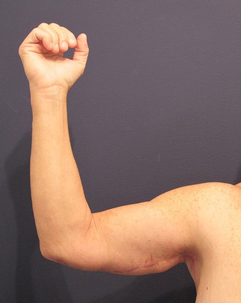 Arm Lift Before & After