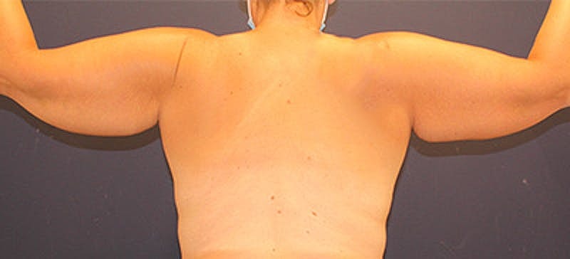 Arm Lift Before & After