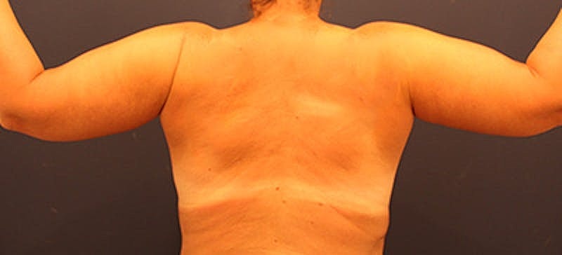 Arm Lift Before & After