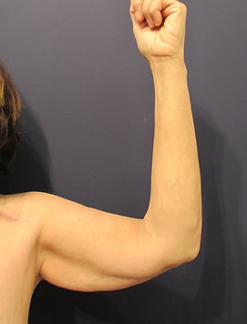 Arm Lift Before & After