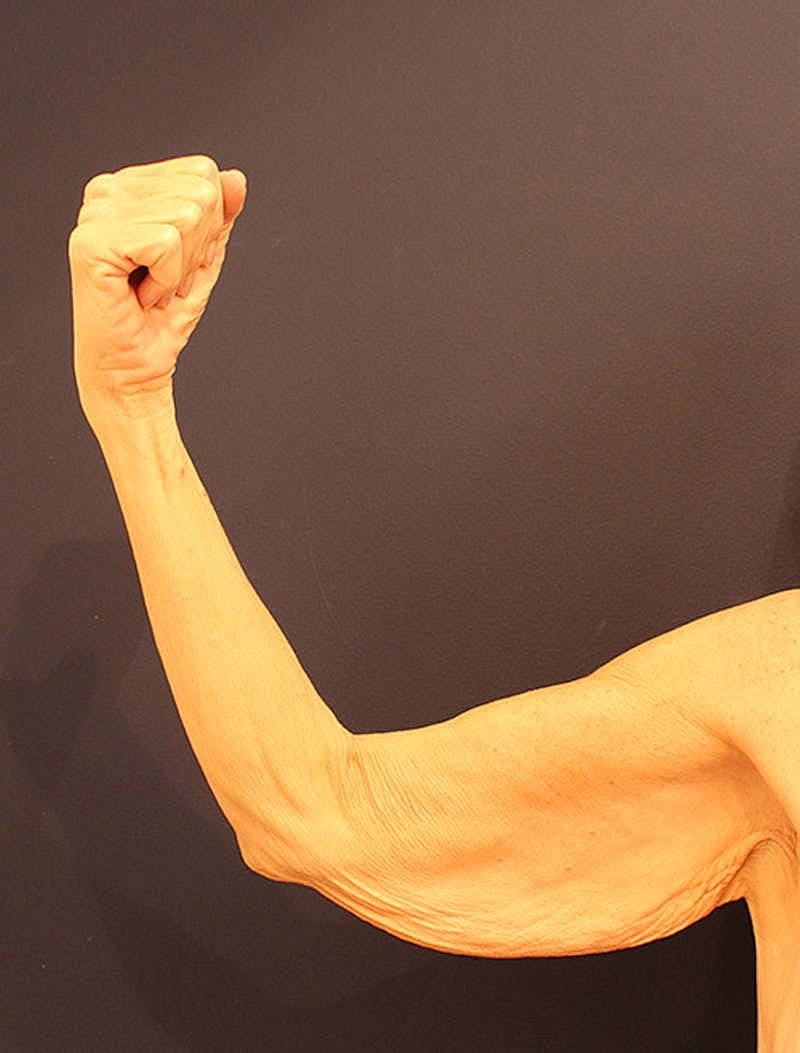 Arm Lift Before & After