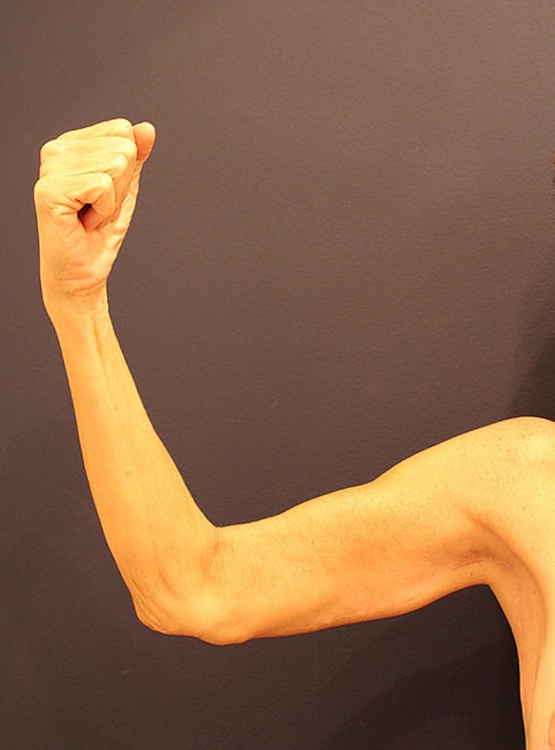Arm Lift Before & After