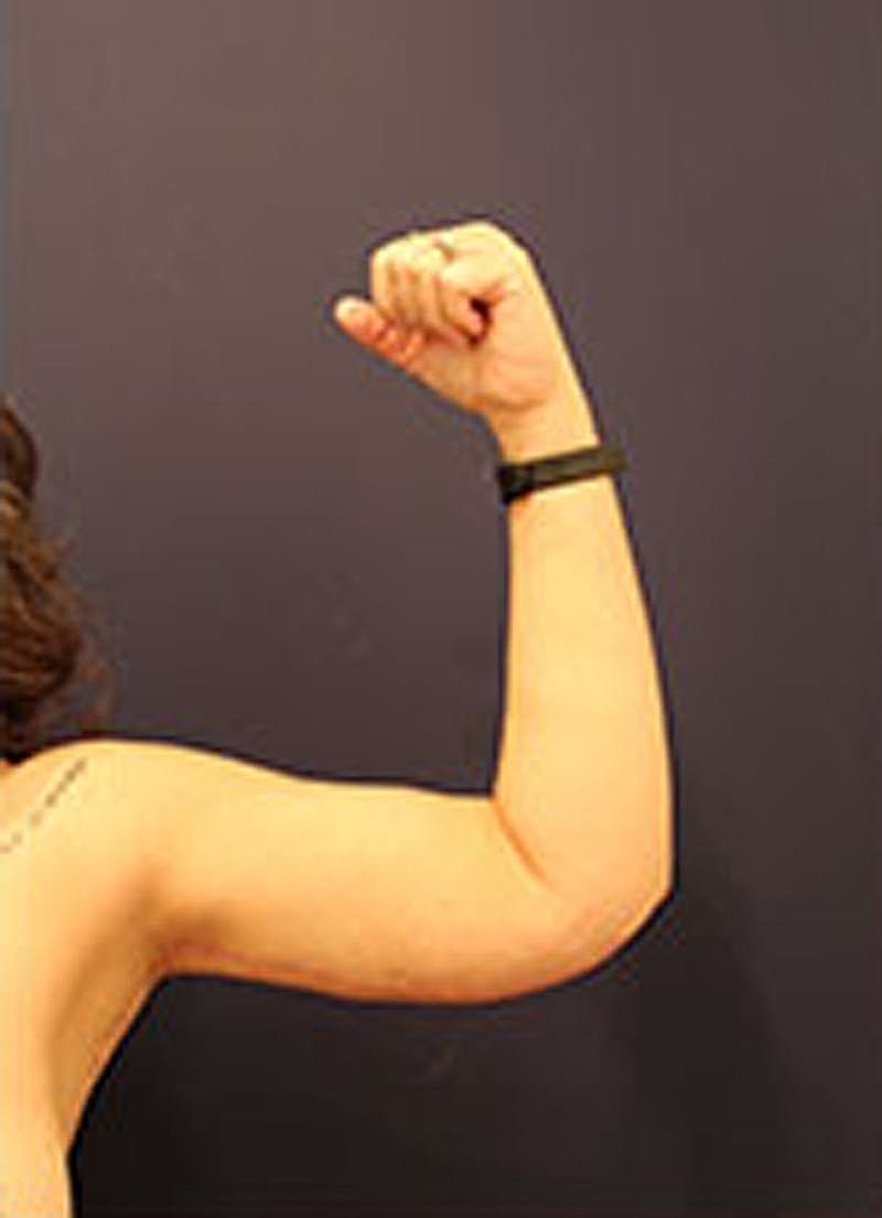 Arm Lift Before & After