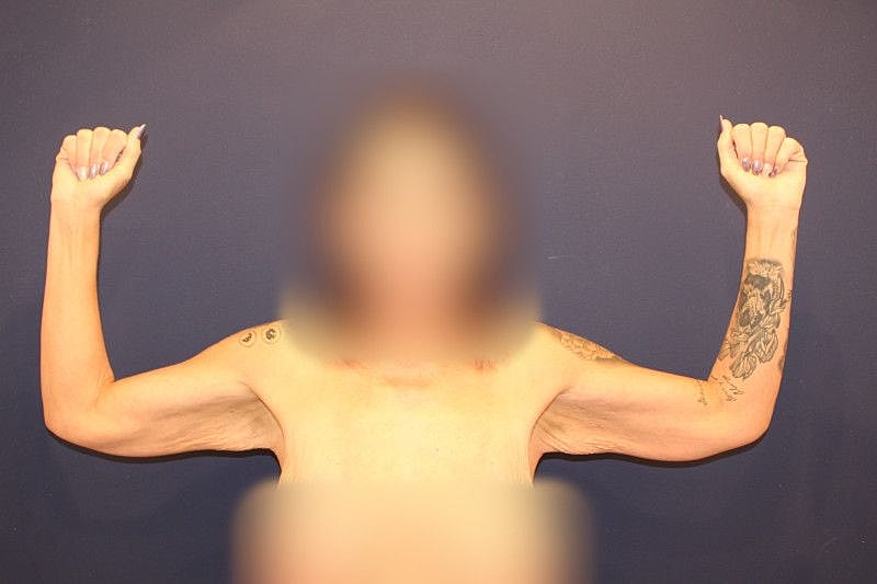 Arm Lift Gallery Before & After