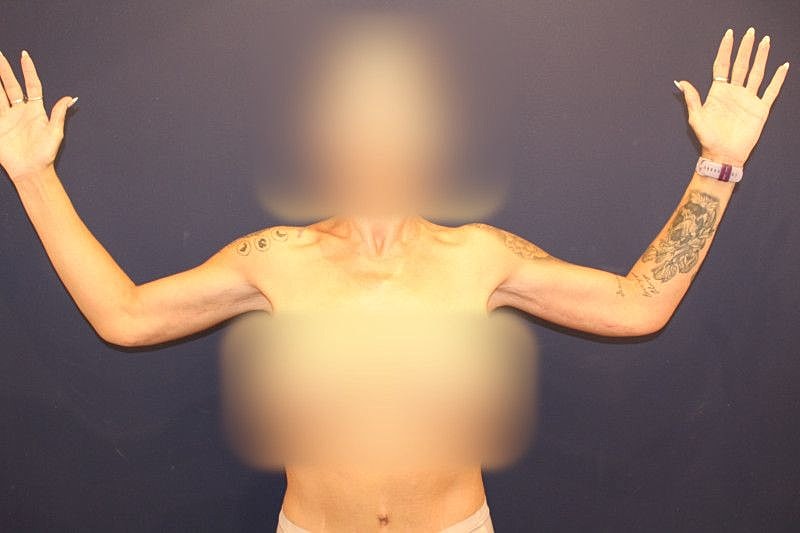 Arm Lift Gallery Before & After
