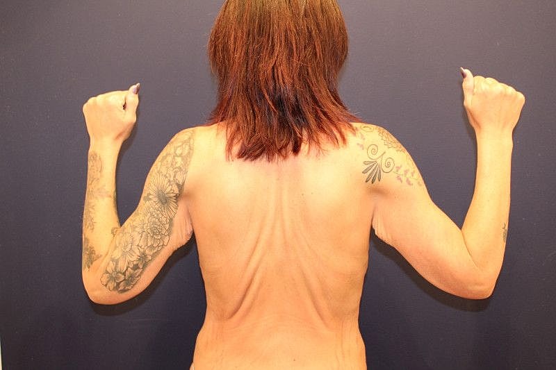 Arm Lift Gallery Before & After