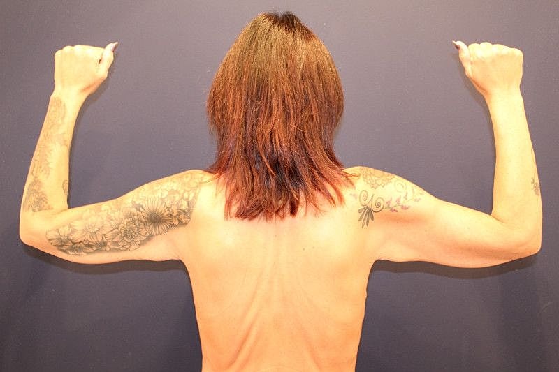 Arm Lift Gallery Before & After
