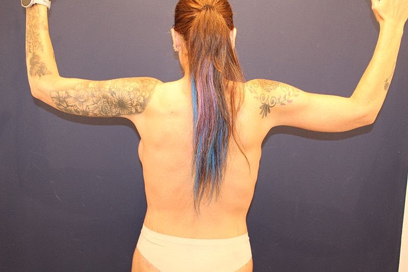 Arm Lift Gallery Before & After