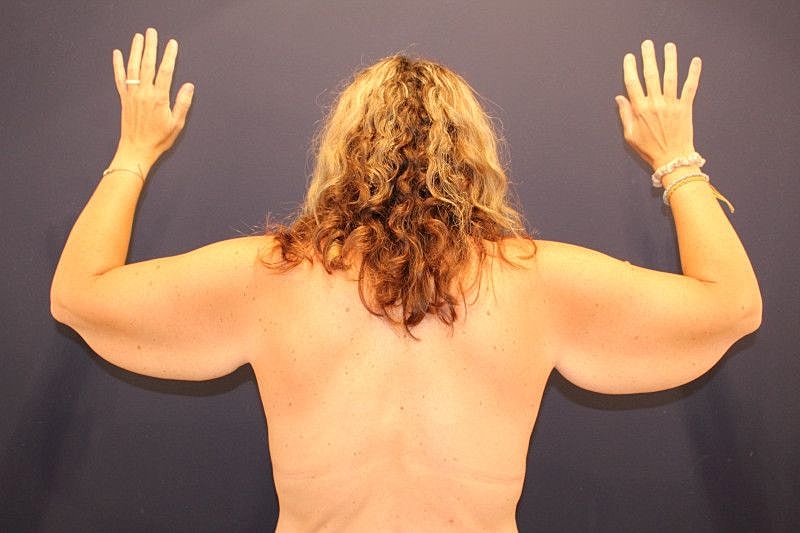 Arm Lift Gallery Before & After