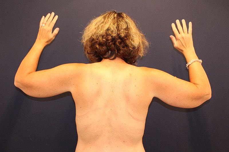 Arm Lift Gallery Before & After