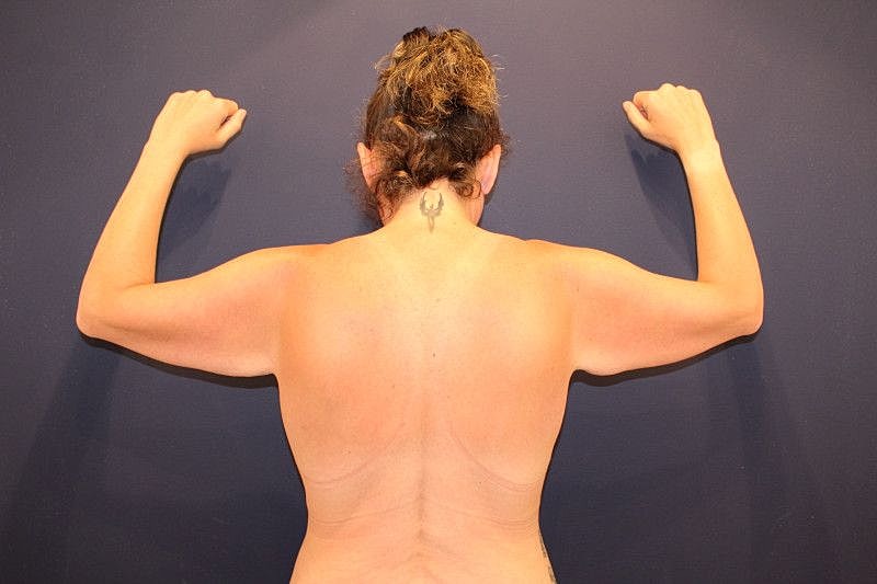 Arm Lift Gallery Before & After