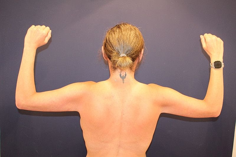 Arm Lift Gallery Before & After