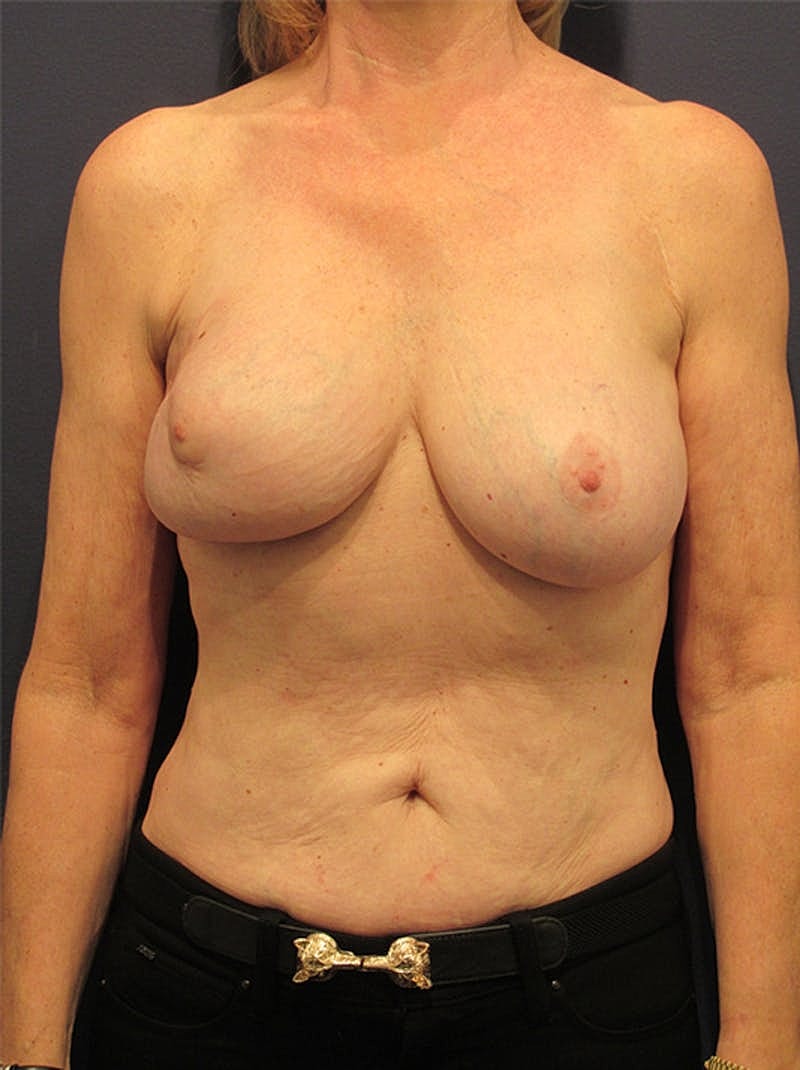 Breast Reconstruction Before & After