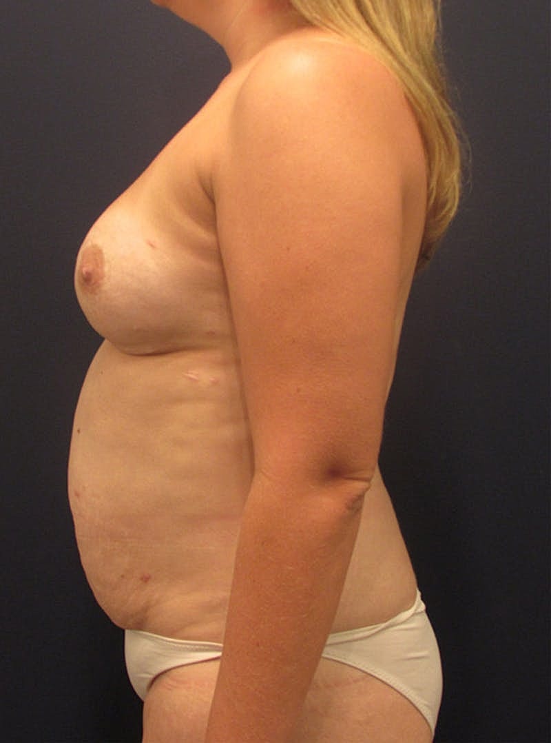 Breast Reconstruction Before & After