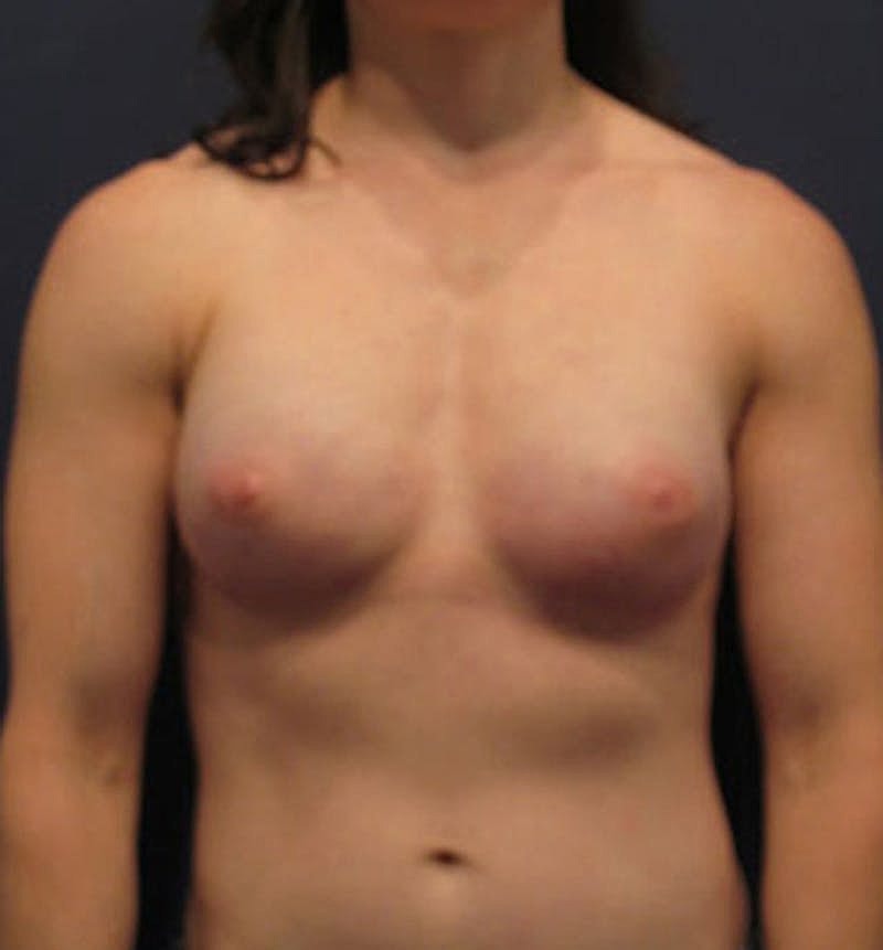 Breast Reconstruction Before & After