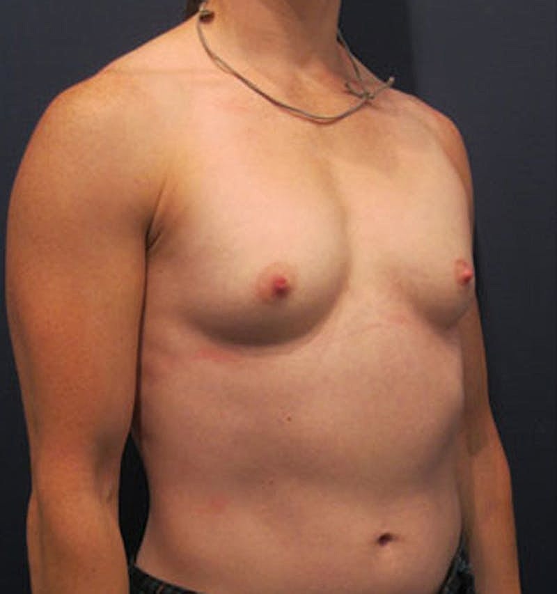 Breast Reconstruction Before & After