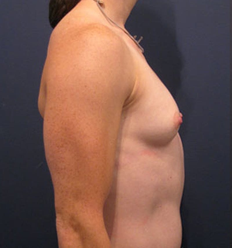 Breast Reconstruction Before & After