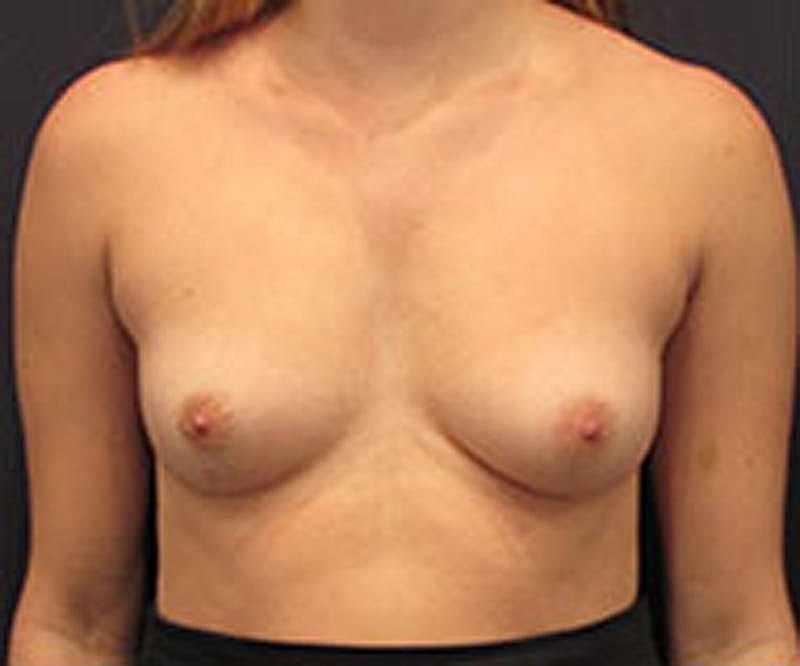 Breast Reconstruction Before & After